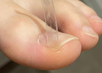 巻き爪補正正規取扱店